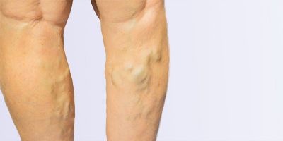 Varicose Veins