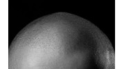 Scalp Micropigmentation