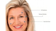 EPN Pen Treatment Microneedling