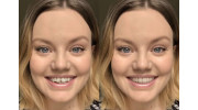 Invisalign