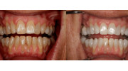 Teeth Whitening