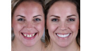 Dental implants