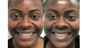Veneers