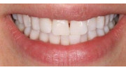 Teeth whitening