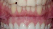 Composite Bonding