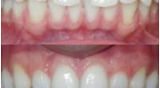 Invisalign