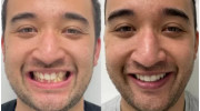 Dental Braces