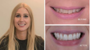 Veneers