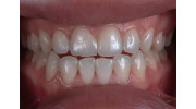 White Fillings