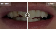 Composite Bonding