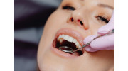 Composite Fillings