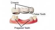 Dental Bridges