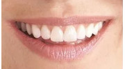 Dental Veneers
