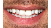 Teeth Whitening