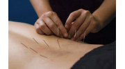 Dry Needling