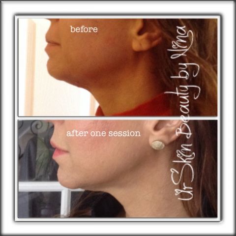 RF for Skin Tightening and Contouring