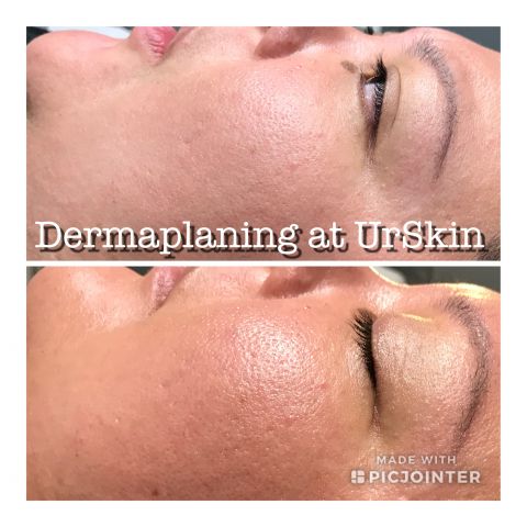 More even skin with Dermaplaning