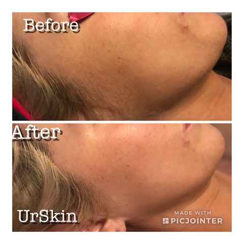 Dermaplaning + Enzyme Peel