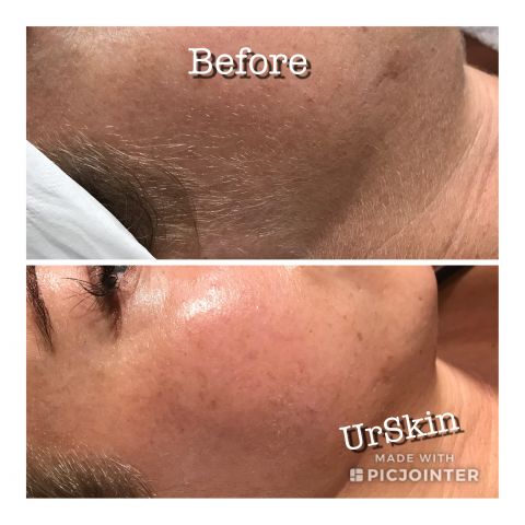 Glowing Skin with Dermaplaning
