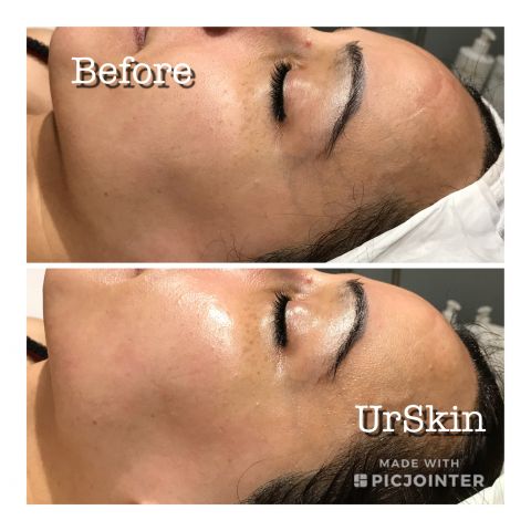 Smoother Skin with Dermaplaning